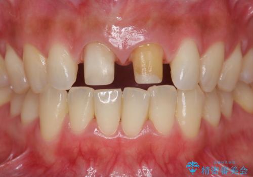 短期集中  前歯審美治療の治療中