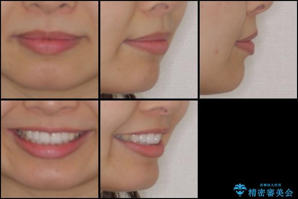 口が閉じにくい 1本飛び出した前歯の矯正治療の治療後(顔貌)