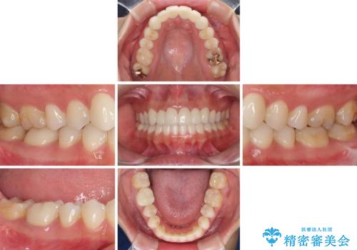 気になる前歯を審美歯科治療と矯正歯科治療で美しくの治療後