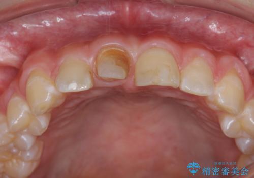 前歯をきれいにしたい ジルコニアクラウンによる審美治療の治療中