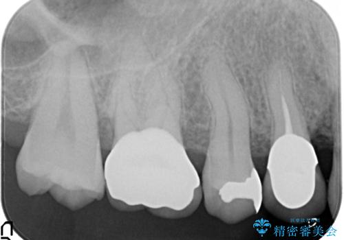 セラミッククラウンによるむし歯治療の治療後