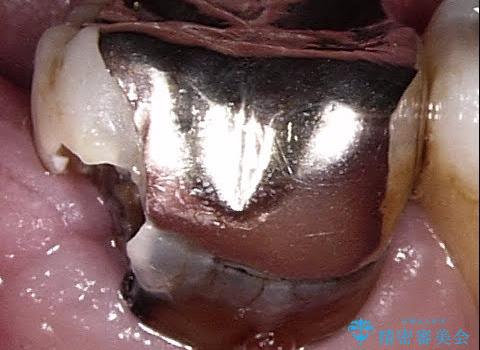 一番奥歯の後ろに虫歯が　処置の難しい虫歯の治療中