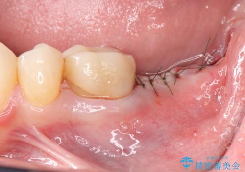 最後方臼歯のインプラント補綴の治療中