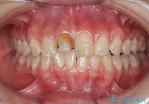 前歯をきれいにしたい ジルコニアクラウンによる審美治療の治療中