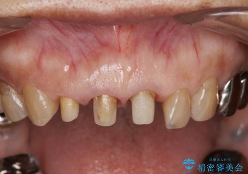前歯の審美改善の治療中