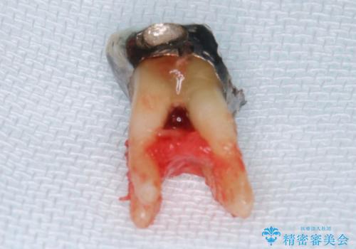 見えない歯周病 長期予後を見据えてインプラントにの治療前