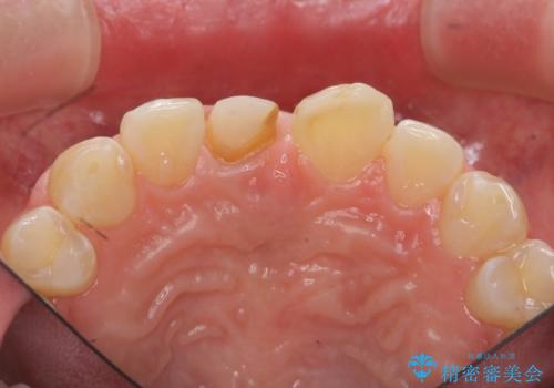 前歯をきれいにしたい ジルコニアクラウンによる審美治療の治療中