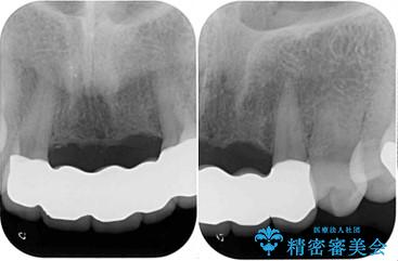 古くなった前歯のブリッジをオールセラミックにの治療後