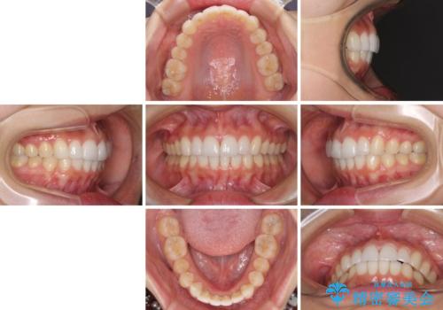 口が閉じにくい 1本飛び出した前歯の矯正治療の治療後
