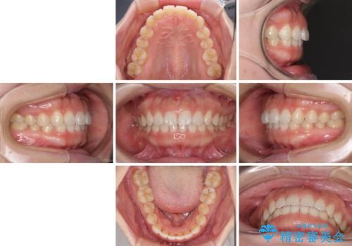 前歯のデコボコを治したい　インビザラインによる矯正治療の治療後