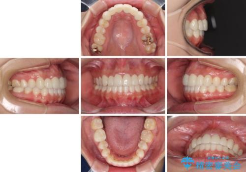 気になる前歯を審美歯科治療と矯正歯科治療で美しくの治療後