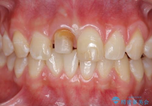前歯をきれいにしたい ジルコニアクラウンによる審美治療の治療中