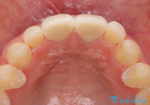 短期集中  前歯審美治療の治療後
