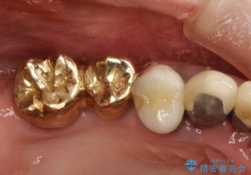 薄い骨にもインプラントを スプリットクレスト+ショートインプラントの応用の治療前