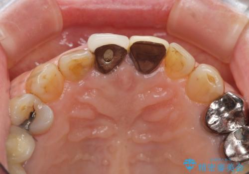 前歯の審美改善の治療前