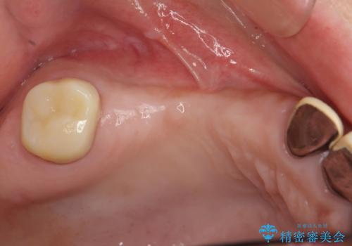 他院で中途半端に終わってしまったインプラント治療 の治療前