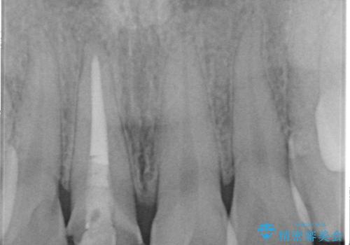 変色した歯をセラミックにしたい　歯自体が変色している場合の参考用2の治療中