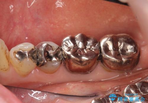 オールセラミッククラウン PGA(ゴールド)クラウン 古い銀歯の治療の治療前