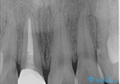 変色した歯をセラミックにしたい　歯自体が変色している場合の参考用2の治療後
