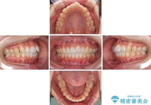 口が閉じにくい 1本飛び出した前歯の矯正治療の治療中
