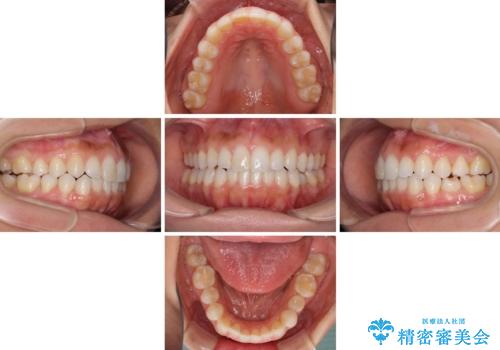 前歯の叢生を治したい インビザラインによる矯正治療の治療中