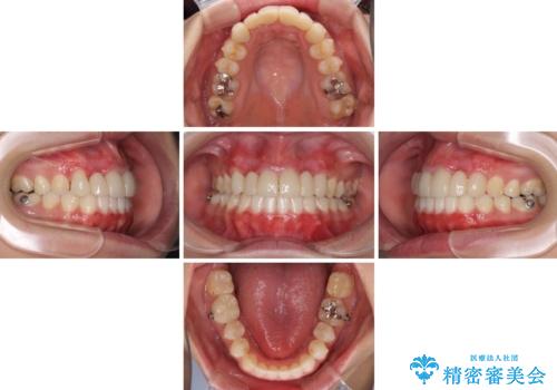 気になる前歯を審美歯科治療と矯正歯科治療で美しくの治療中