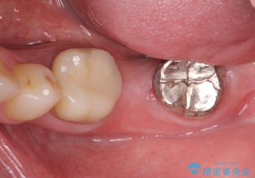 最後方臼歯のインプラント補綴の治療中