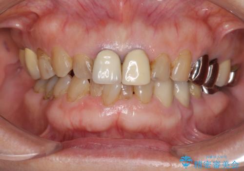 前歯の審美改善の治療前