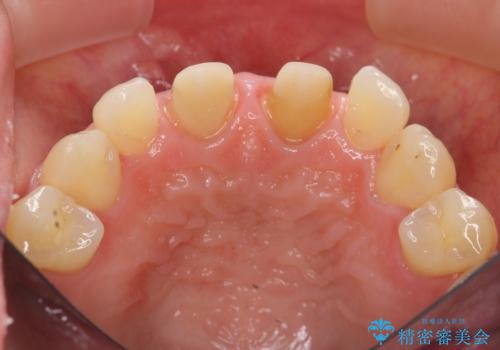 短期集中  前歯審美治療の治療中
