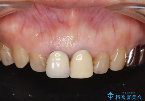 前歯の審美改善の症例 治療前
