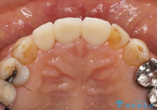 前歯の審美改善の治療後