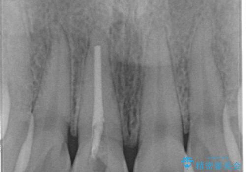 変色した歯をセラミックにしたい 歯自体が変色している場合の参考用2の治療前