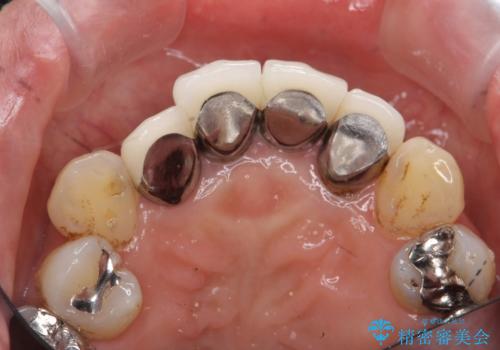 歯茎の黒ずみがきになる　前歯の見た目を改善したいの治療前