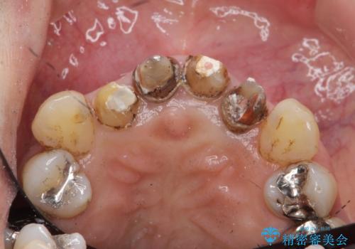 歯茎の黒ずみがきになる 前歯の見た目を改善したいの治療前