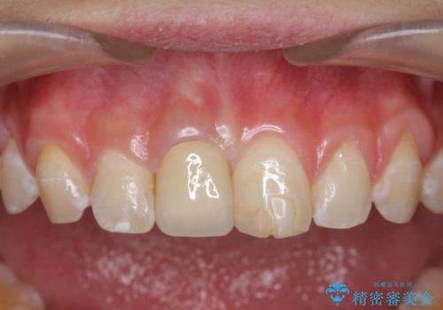 前歯をきれいにしたい ジルコニアクラウンによる審美治療の治療後