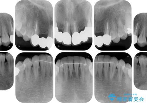気になる前歯を審美歯科治療と矯正歯科治療で美しくの治療後