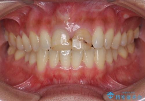 短期集中  前歯審美治療の治療前