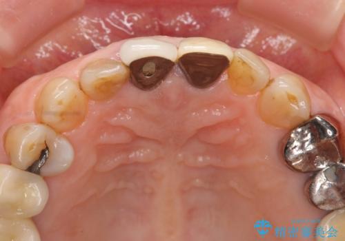 前歯の審美改善の治療前