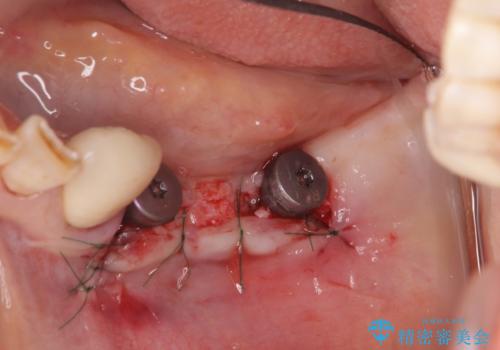 歯を失い噛めない、インプラントによる咬合機能回復の治療中