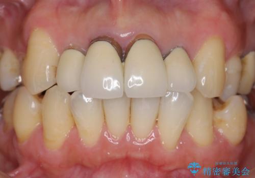 歯茎の黒ずみがきになる 前歯の見た目を改善したいの治療前