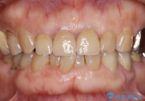 前歯の審美改善の治療後