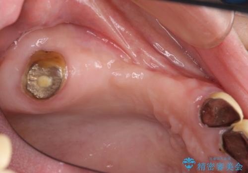 他院で中途半端に終わってしまったインプラント治療 の治療前