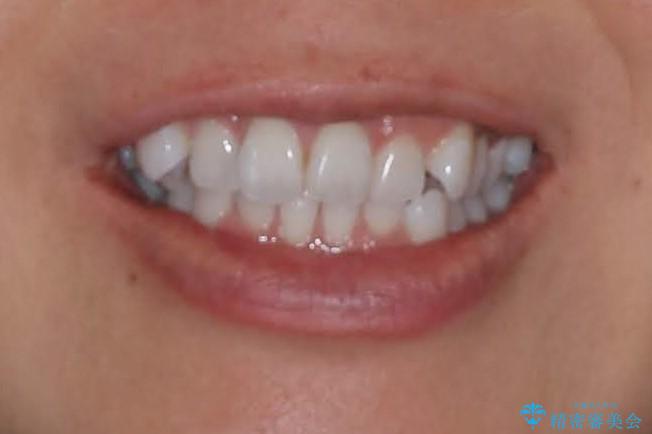 抜歯せずに八重歯のマウスピース矯正の治療前(顔貌)