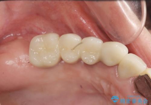 他院で中途半端に終わってしまったインプラント治療 の治療後