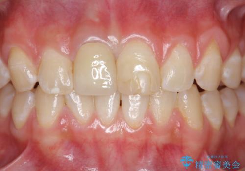前歯をきれいにしたい ジルコニアクラウンによる審美治療の治療後