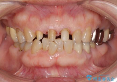 前歯の審美改善の治療中