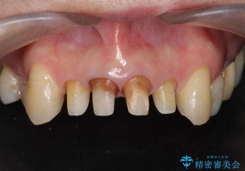 歯茎の黒ずみがきになる 前歯の見た目を改善したいの治療中