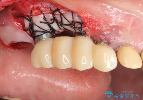 他院で中途半端に終わってしまったインプラント治療 の治療後