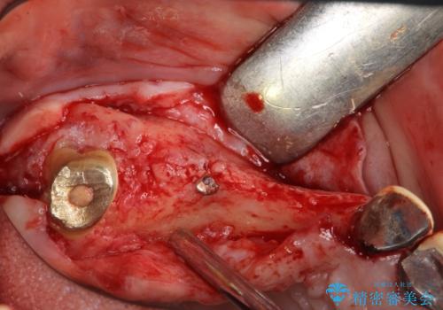 他院で中途半端に終わってしまったインプラント治療 の治療中