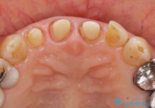 前歯の審美改善の治療中